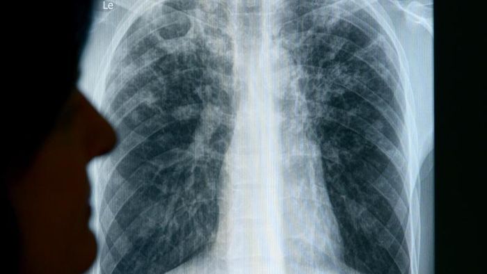 Tuberkulose nach wie vor eine Herausforderung in Europ